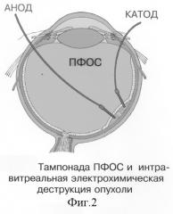 Способ электрохимической деструкции, хирургического удаления и фотодинамической профилактики рецидивов внутриглазных новообразований в среде перфторорганического соединения (варианты) (патент 2244533)