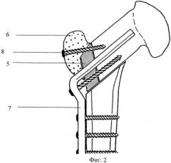 Способ выполнения двойной остеотомии бедренной кости (патент 2531444)