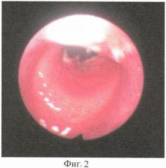 Способ прогнозирования стенозов трахеи после длительной интубации и трахеостомии (патент 2412445)