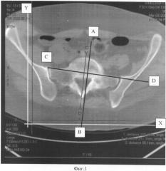 Способ определения величины ротации таза и плечевого пояса у больных тяжелой формой коксартроза по данным кт исследования (патент 2377953)