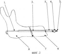 Устройство для внутриочагового компрессионного остеосинтеза челюстей (патент 2261680)