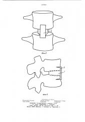 Фиксатор позвоночника (патент 1107854)