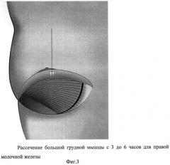 Способ формирования кармана для имплантата в двойственной плоскости при аугментационной маммопластике (патент 2498777)