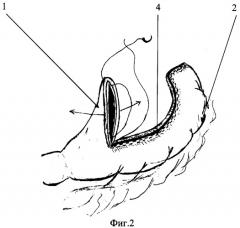 Способ создания желудочной трубки для пластического замещения пищевода (патент 2332173)
