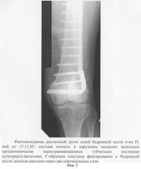 Способ лечения пострезекционных полостей трубчатых костей (патент 2322207)