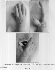 Способ лечения врожденной гипоплазии первого пальца кисти (патент 2297190)