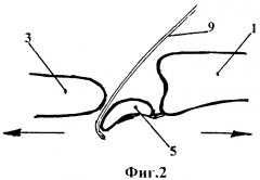 Способ вправления застарелого вывиха полулунной кости кисти (патент 2483686)