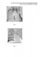 Способ катетеризации и способ эндоваскулярной окклюзии бронхиальных и межрёберных артерий (патент 2661097)