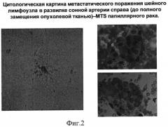 Способ фотодинамической терапии онкологических заболеваний (патент 2537759)