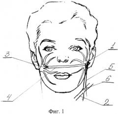 Способ устранения паралича мимических мышц (патент 2566215)