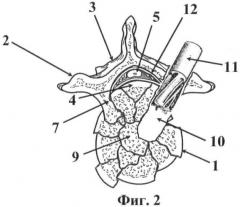 Способ декомпрессии спинного мозга при переломах грудных и поясничных позвонков (патент 2467716)