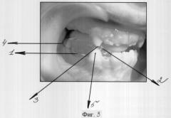 Ортодонтическое устройство (патент 2309703)
