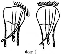 Способ хирургического лечения оскольчатых переломов проксимального отдела плечевой кости напряженными спицами (патент 2357692)
