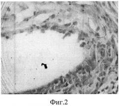 Способ укрепления шва на матке при операции кесарево сечение с применением синтетического эндопротеза (патент 2559281)