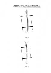 Способ удлинения бедренной кости поверх интрамедуллярного стержня (патент 2638279)