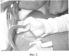 Способ оценки функции схвата кисти у детей при врожденных и приобретенных дефектах (патент 2425624)