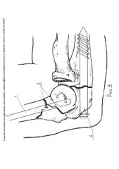 Способ остеосинтеза переломов дистального эпиметафиза плечевой кости и устройство для его осуществления (патент 2587965)