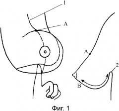 Способ мастопексии в сочетании с редукцией молочной железы (патент 2339316)