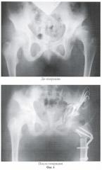 Способ лечения маргинального вывиха бедра у детей (патент 2371135)