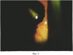 Способ экспериментального моделирования коркового вида катаракты in vivo (патент 2553577)