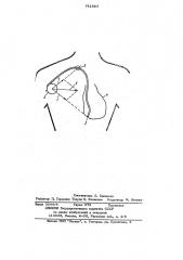 Способ определения повреждения имплантированного эидокардиального электрода (патент 741887)