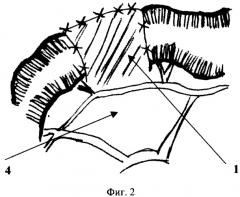 Способ лоскутной перитонизации кишечника для профилактики развития послеоперационных спаек в абдоминальной хирургии (патент 2275865)