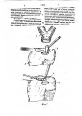 Способ формирования билиодигестивного анастомоза (патент 1718838)