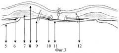 Способ аллопластики вентральных грыж (патент 2348363)