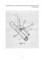 Способ кроссэктомии с лигированием ствола большой подкожной вены выше и ниже притоков (патент 2607919)
