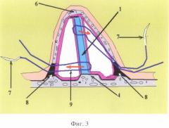 Способ репозиции и фиксации хряща носовой перегородки при его вывихе, сочетающемся с наружной травматической деформацией носа (патент 2497470)