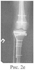 Способ хирургического лечения множественных переломов длинных костей нижних конечностей (патент 2414183)