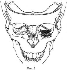 Способ восстановления нижней стенки глазницы и нижнеглазничного края после травмы (патент 2486872)