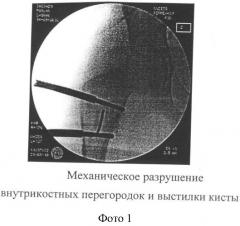 Способ лечения кист костей и устройство для его осуществления (патент 2420243)