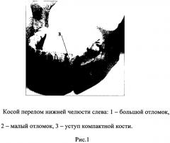 Способ костного шва для фиксации косых переломов нижней челюсти (патент 2565818)