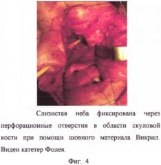 Способ фиксации слизистой неба при резекции верхней челюсти (патент 2576796)