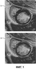 Автоматическая трехмерная сегментация изображения сердца по короткой оси, полученного методом магнитно-резонансной томографии с отложенным контрастированием (патент 2503061)