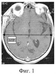 Способ оценки внутричерепного анатомического резерва при дислокации головного мозга (патент 2517767)