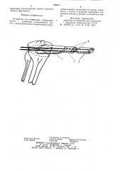 Устройство для остеотомии (патент 888974)