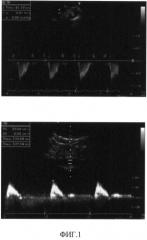 Способ выявления повышенной жесткости аорты у пациентов с кардиопатологиями (патент 2511059)
