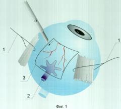 Способ супраувеальной декомпрессии ампулы вортикозной вены глазного яблока (патент 2312644)