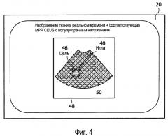 Интервенционная навигация с использованием трехмерного ультразвука с контрастным усилением (патент 2494676)