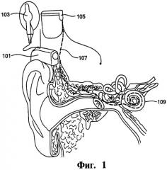 Кохлеарная протезирующая система, система стимуляции и машиночитаемый носитель информации (варианты) (патент 2440156)