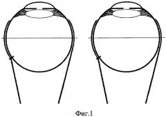Способ хирургического лечения горизонтального толчкообразного нистагма (патент 2272601)