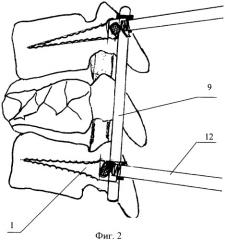 Способ хирургического лечения больных с травматическим повреждением позвонков и устройство для его осуществления (патент 2382616)
