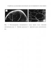 Устройство для инъекции диплоических вен изолированного свода черепа (патент 2625652)
