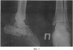 Способ репозиции переломов пяточной кости с большим смещением отломков (патент 2385683)