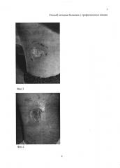 Способ лечения больных с трофическими язвами (патент 2620498)