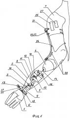Протез предплечья (патент 2615278)