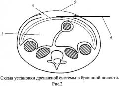 Способ создания активной лапаростомии (патент 2567666)