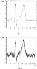 Способ подавления шумов в электрокардиосигнале (патент 2440022)